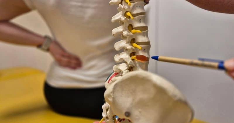 Hernija diska - prikaz zdrsa diska na modelu hrbtenice.
