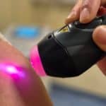 Laserska terapija pomaga tudi pri herpesu